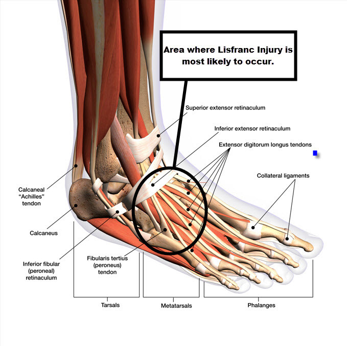 Lisfranc Injury of the Foot JOI Jacksonville Orthopaedic Institute