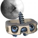 image of STALIF M TI Lumbar Fusion Device