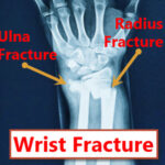 Distal radius fractures are the miost common wrist fractures to occur to the human wrist bone. JOI Rehab