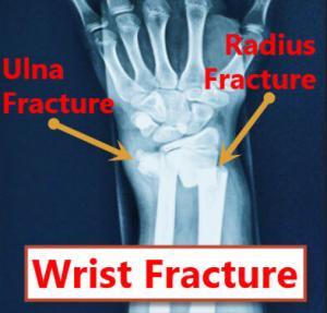 Distal radius fractures are the most common wrist fractures to occur to the human wrist bones. JOI Rehab