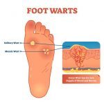 image of foot with a plantar wart.