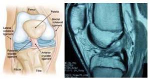 MRI of the ACL