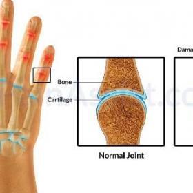 Артрит и артроз суставов пальцев. Как лечить артроз пальца кисти. Узелки гебердена ревматоидный артрит. Как лечить артроз пальца кисти. Деформирующий остеоартроз кистей.
