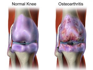 Arthritis