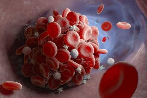 Preventing blood clots after surgery is a vital part of recovery.