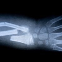 Forearm Fracture on X-ray