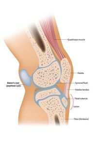 Baker's Cyst is lump behind the knee and can be painful