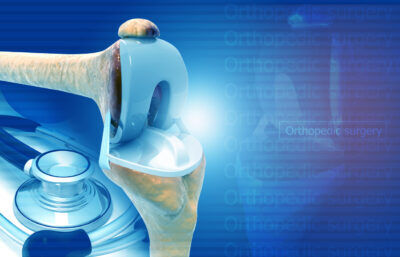 Partial Knee Replacement