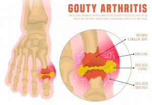 Gout arthritis Gouty Arthritis
