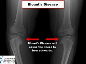 X-ray image of bowed legs from an individual suffering with Blount's disease. JOI Rehab