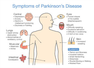 Illustration showing the symptoms of parkinson's disease which can be treated by LSVT BIG. JOI Rehab