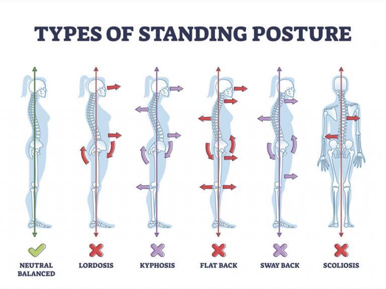 What is Posture & Can it be Corrected? JOI & JOI Rehab