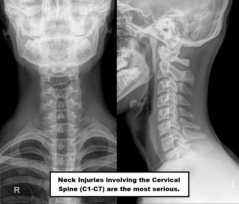 Common Neck Injuries and Preventative Exercises JOI Rehab