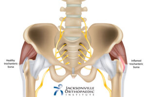 Illustration of hip bursitis. JOI Rehab