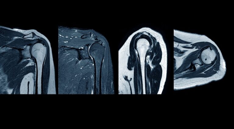 invasive shoulder pain relief