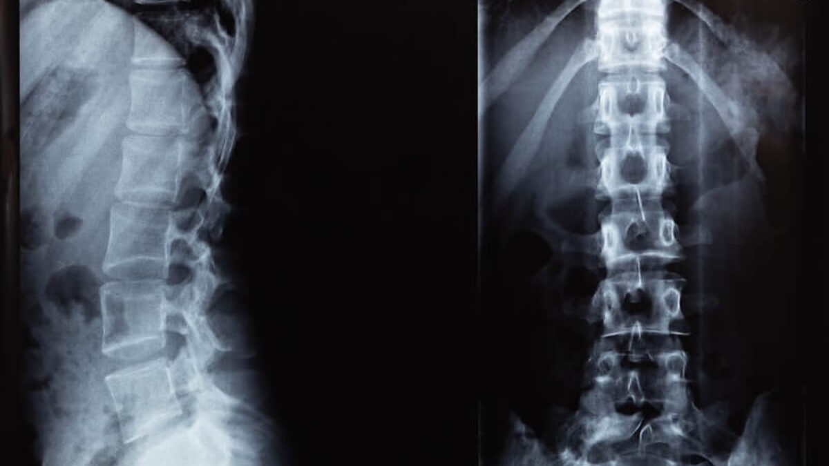 Common Spine Disorders: Diagnosing and Treating Back Pain