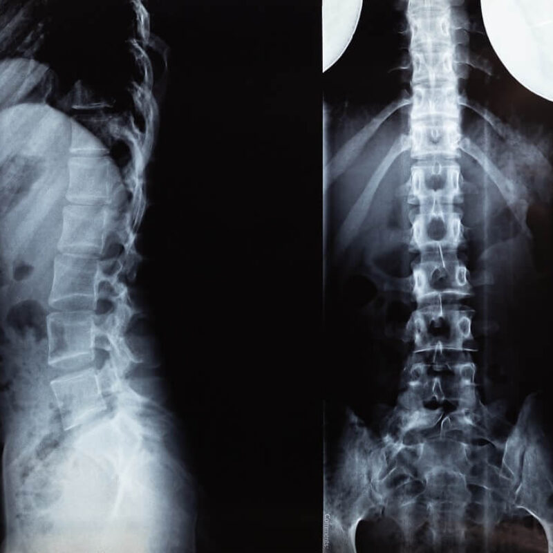 Common Spine Disorders: Diagnosing and Treating Back Pain