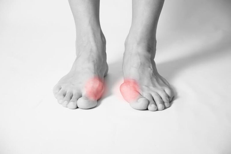 Managing bunion pain