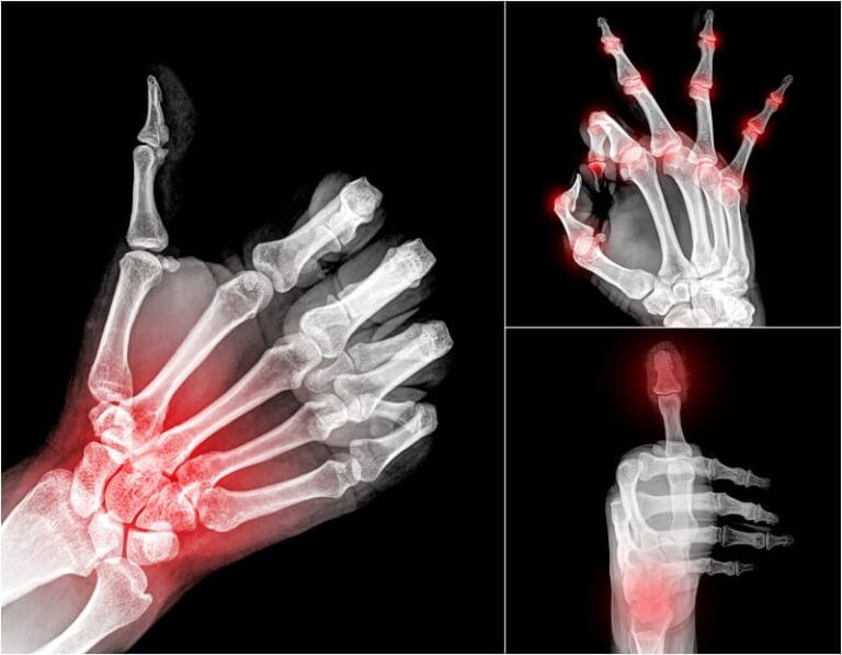 arthritis pain