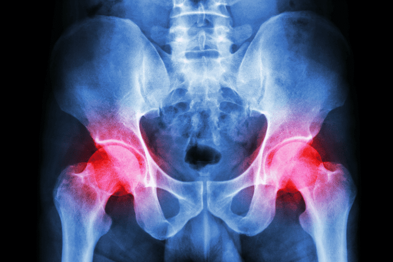 hip arthroscopy