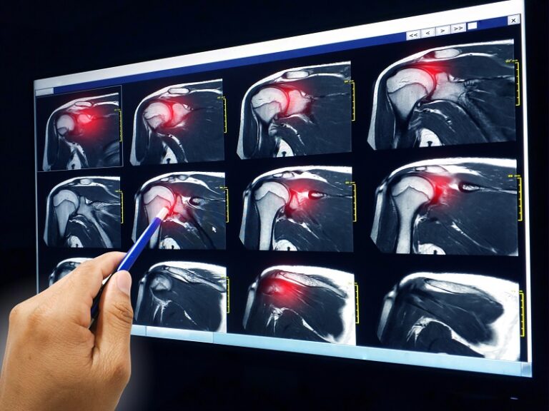 rotator cuff tear symptoms