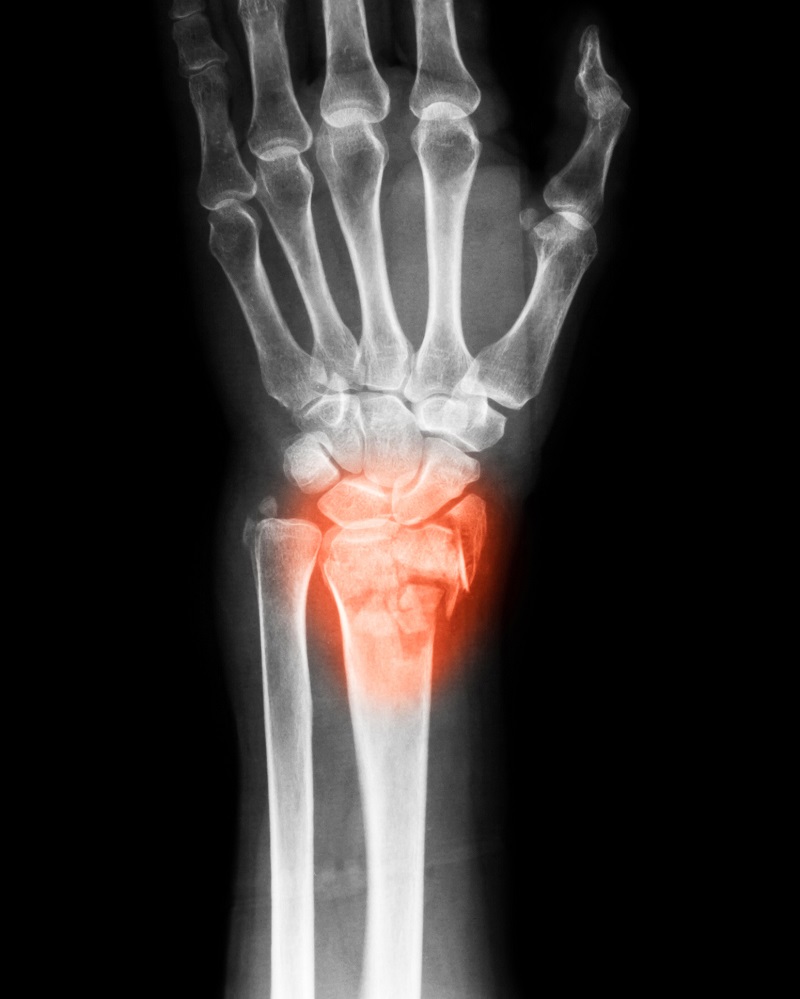 x-ray of wrist arthritis