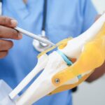 How Long Do Joint Replacements Really Last
