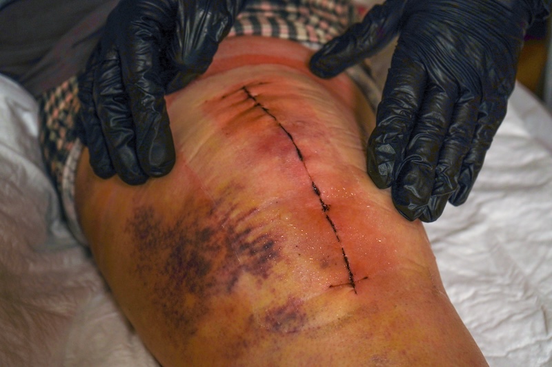 The doctor is assessing the condition of her knee, which has a scar from the procedure.