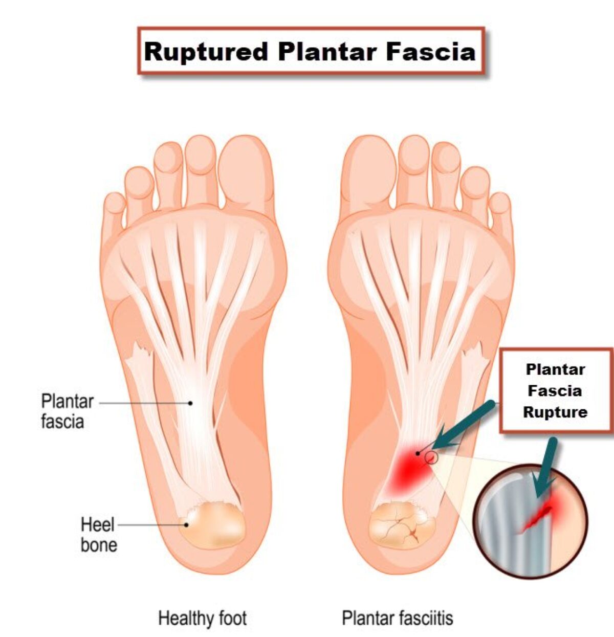Bottom Foot Tendons Plantar Fasciitis Rupture: Symptoms, Treatments