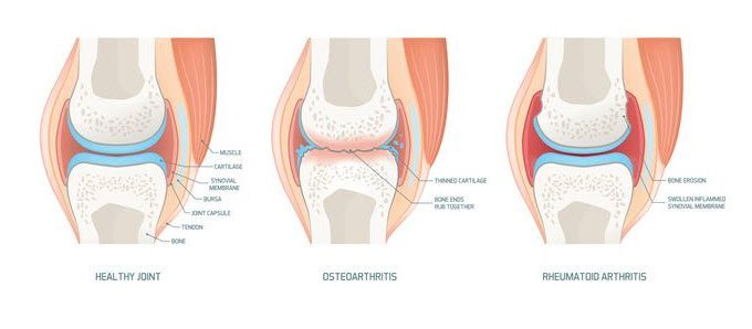 Image of 3 knees with anatomy showing healthy knee, osreoarthritis in a knee, and rheumatoid arthritis in a knee.