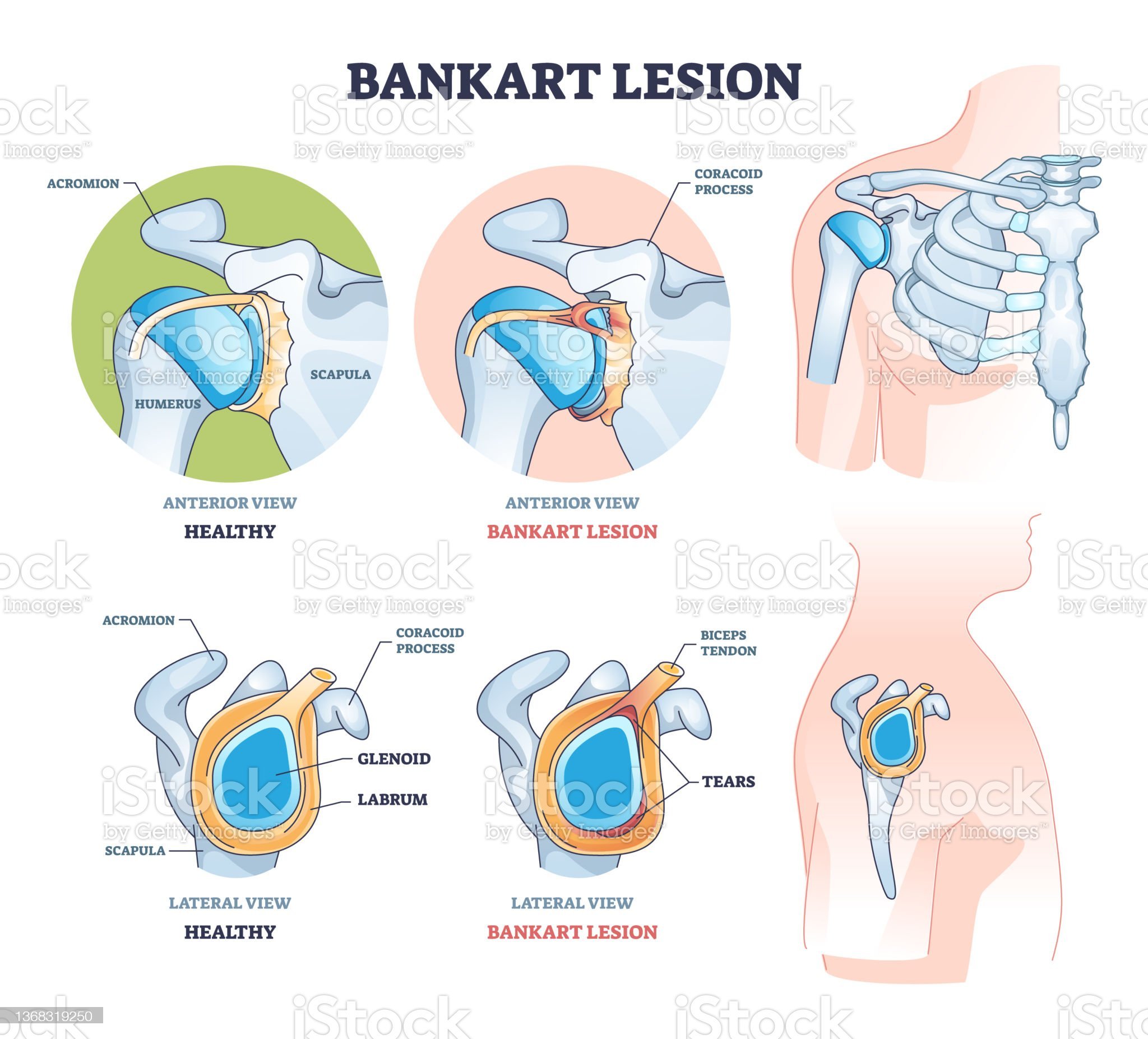 Bankart Lesion of the Shoulder