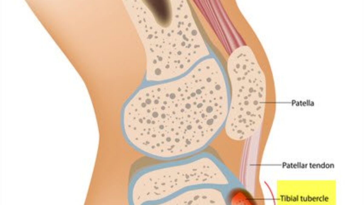 Tibial Tuberosity