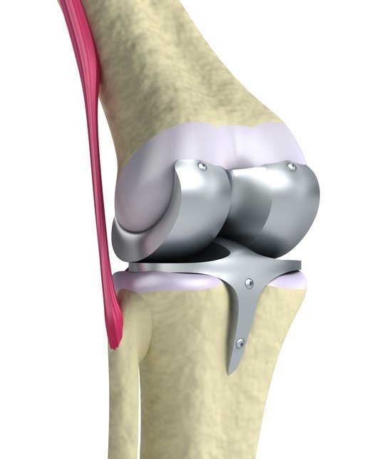 knee replacement longevity can vary