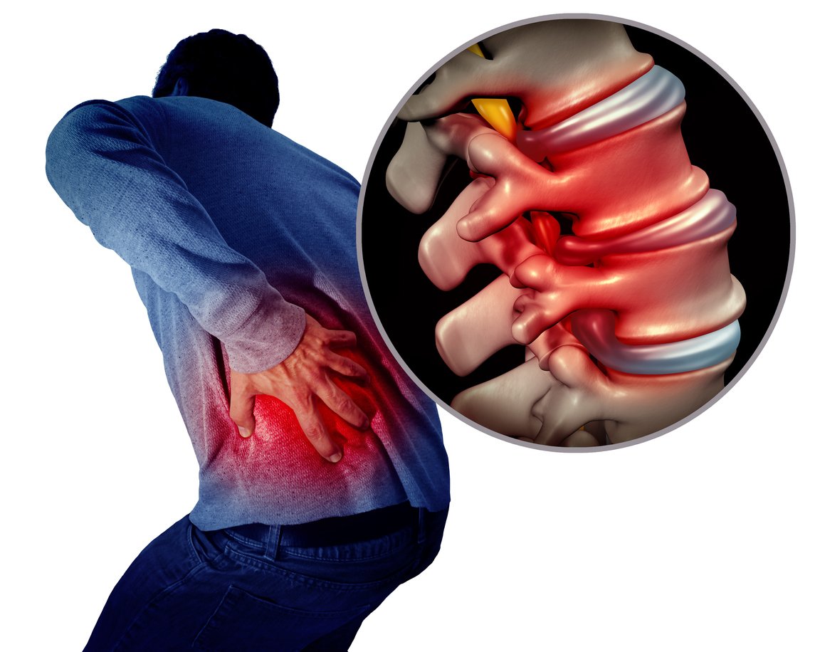 Highlighted spinal discs showing back lower pain. JOI Rehab 