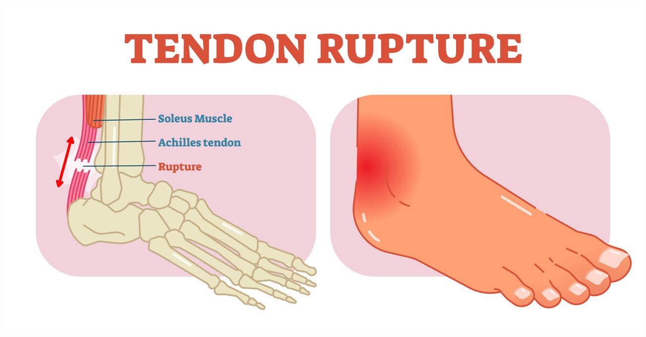 Illustration of an achilles tendon rupture and ankle pain highlighted red. JOI Rehab