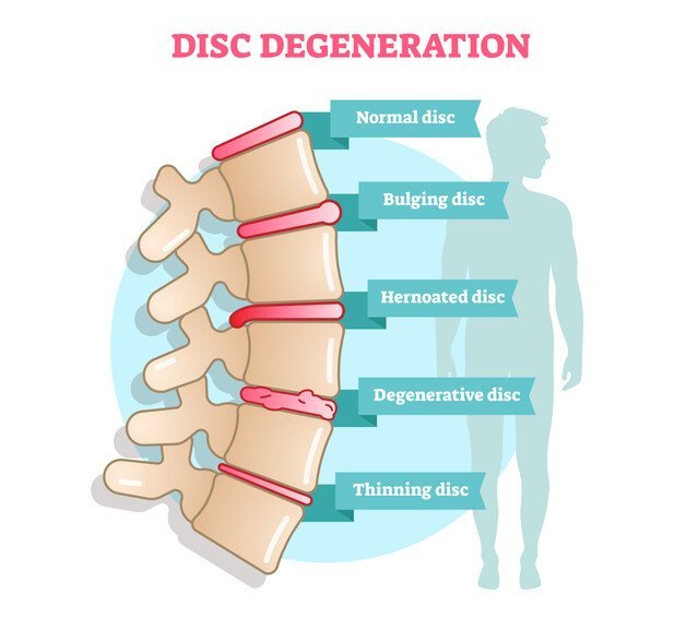 Disc degeneration may be a cause of lower back pains. JOI Rehab