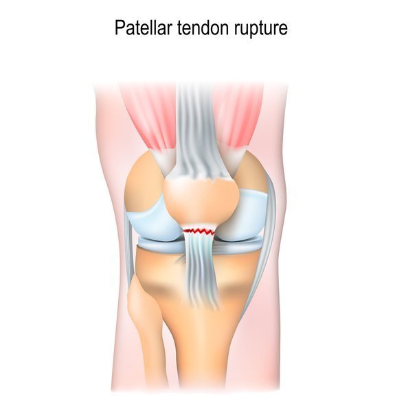 Anatomical Image of a patellar tendon rupture