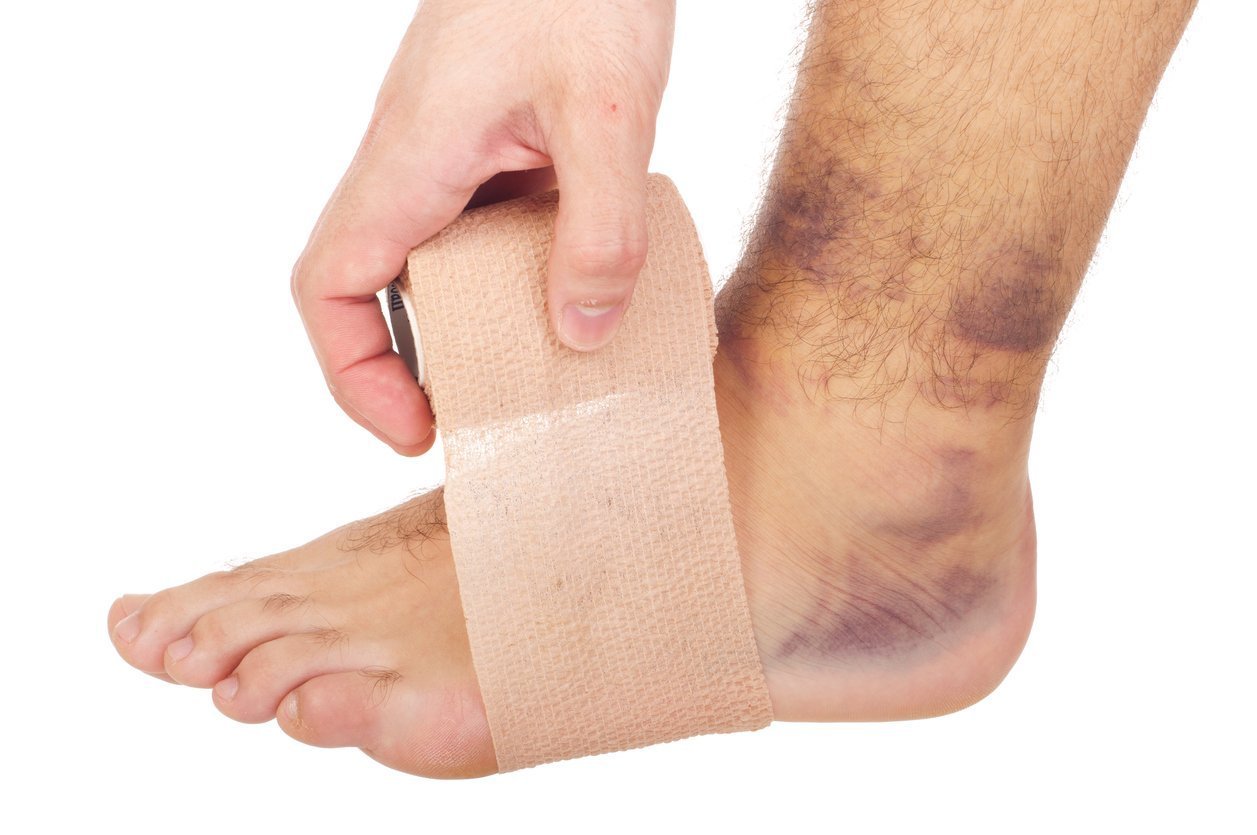 Treatment for a sprained ankles can include Rest, Ice, compression, and elevation.  JOI has the answers for your ankle sprain.