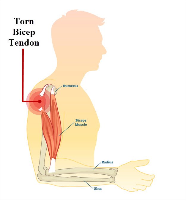 Illustration of a man with a torn bicep tendon injury. JOI Rehab