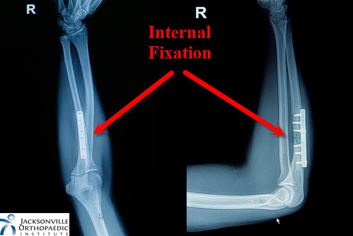 X-ray of an internal fixation. JOI Rehab