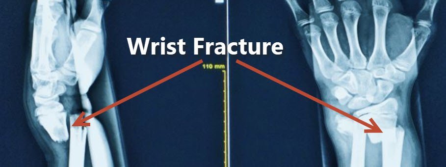 Wrist Xray Broken Radius