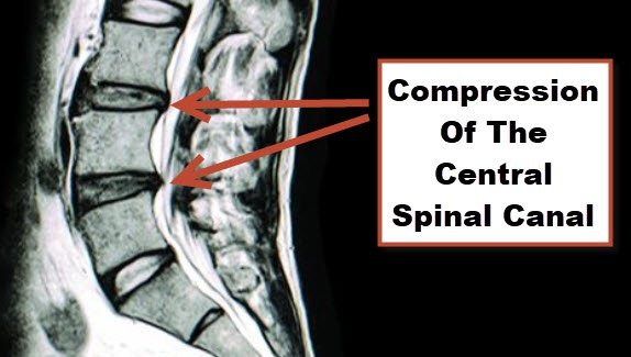 MRI image of disc herniation causing compression of the central spinal canal with Stenosis or lower back pain. JOI Rehab