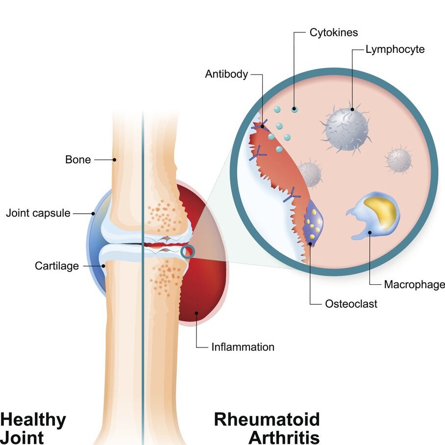 glutathione and rheumatoid arthritis Glutathione and Autoimmune Disease