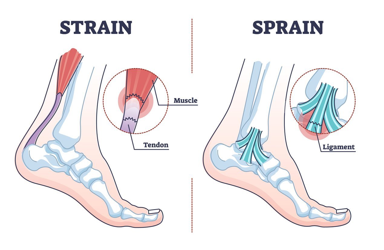 A torn tendon in foot and ankle ligament sprains can be mistaken for top of foot tendonitis as well as pain located in the extensor tendon foot. JOI Rehab