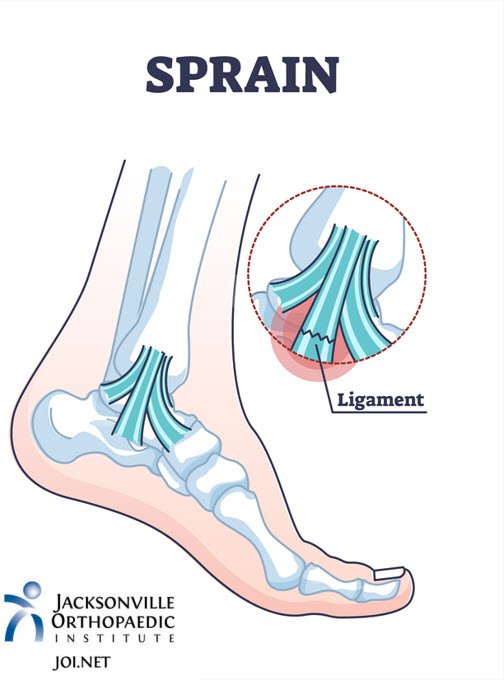 Illustration of an ankle sprain showing damage to the ankle ligament. JOI Rehab